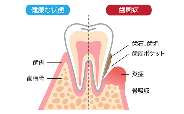 歯周病のことを知っていますか？